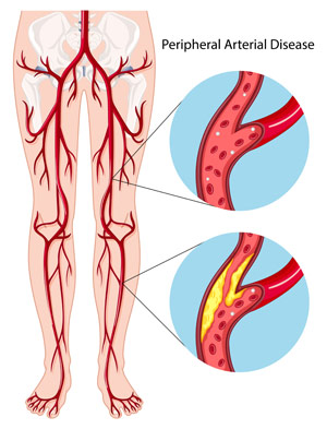 diagram of the legs showing normal and diseased peripheral arteries