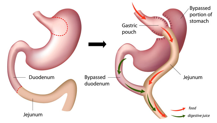 Before and After Roux-en-Y Gastric Bypass Surgery Illustration