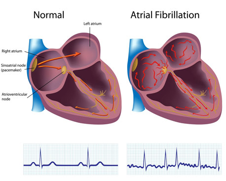 A-maze-ing New Procedure for Afib | BIDMC of Boston