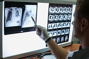 Doctor examines chest x-rays of patient with COPD.