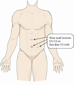 Laprenal Cyst Incision