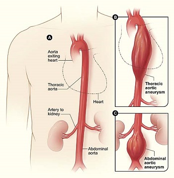 Aortic Aneurysm and Aortic Dissection BIDMC of Boston